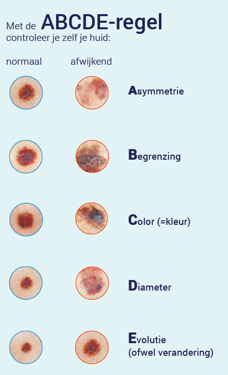 Belofte kraai ondanks Tips en adviezen bij een afwijkend plekje op de huid - Dermatologie