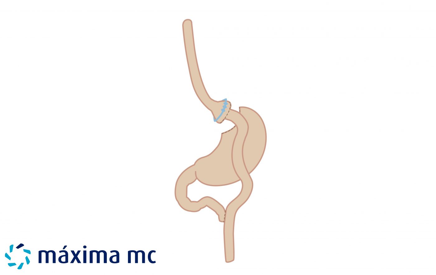 banded bypass