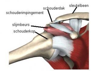 impingement van de schouder 