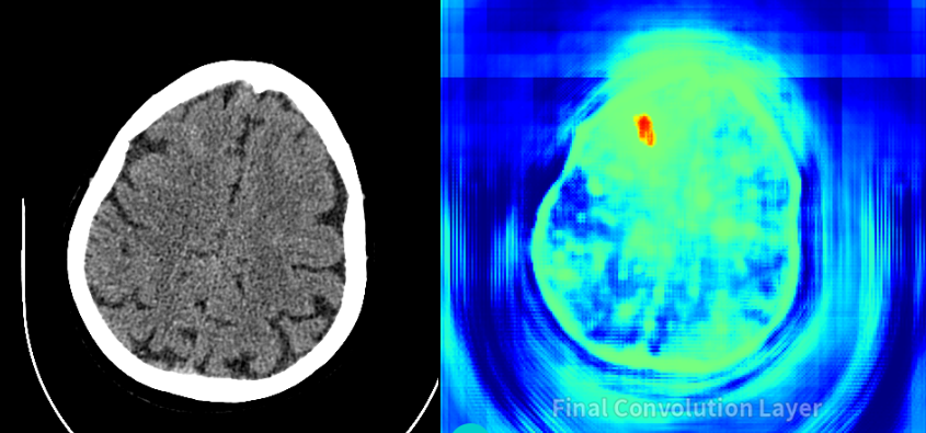 CT schedel bloeding AI