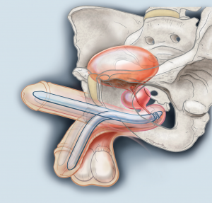 Erectieprothese