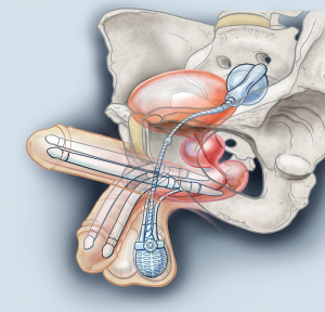 Erectieprothese opblaasbaar